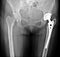 X-ray of hip endoprostheses