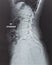 X-ray of human back spine cord radiography with digital imaging film display internal organ of woman patient`s health ribs, pelv