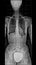 X-ray of human body, from chest to pelvis, complete spinal, scoliosis, front view