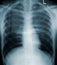 X-Ray Human Chest