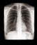X-ray of a human chest front view