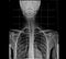 X-ray of human chest and spinal column, front view