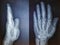 X-Ray of human hand, radiography of hand bones, infected bone in the thumb, top view