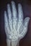 X-Ray of human hand, radiography of hand bones, infected bone in the thumb, top view