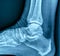 X-ray of human heel spur