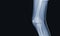 X-ray of human knee showing closed fracture,right distal femur , normal joints and ligaments Medical image concept