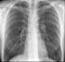 X-ray of a human lungs and thorax of a healthy person