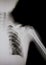 X-ray of human shoulder (broken shoulder)