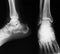 X-ray image of ankle, AP and Lateral view.