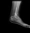X-ray image Ankle foot joint