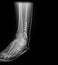 X-ray image Ankle foot joint