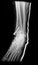 X-ray image Ankle foot joint