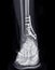 X-ray image of ankle joint showing surgical treatment by internal fixation with plate and screw