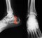 X-ray image of ankle, lateral view.