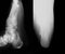 X-ray image of broken calcaneus, AP and axial view.