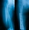 X-ray image of broken femur.