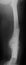 X-ray image of broken femur. AP view.