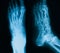 X-ray image of broken foot, AP and lateral view.