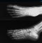 X-ray image of broken foot, AP and lateral view.