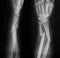 X-ray image of broken forearm, AP and lateral view.