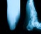 X-ray image of broken heel.