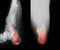 X-ray image of broken heel.