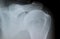 X-Ray image of calcified shoulder Tendinosis calcarea