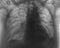 X-ray image after cardiac surgery