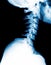 X-Ray image of the cervical spine