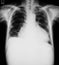 X-ray image of chest, PA upright view.