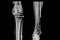 X- Ray image of the distal third of femur and proximal of the tibia with screws  after surgery fue to fracture.