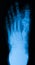 X-ray image of foot fracture, AP view