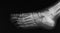 X-ray image of foot, oblique view.