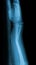 X-ray image of fracture forearm and wooden splint.