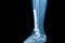X-ray image of fracture leg (tibia )with implant
