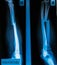 X-Ray Image fracture shaft of radius & ulnar bone for a medica