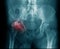 X-ray image hip avascular necrosis