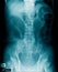 X-ray image of human abdomen, picture of human spine