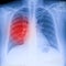 X-Ray Image Of Human Chest for a medical diagnosis, shows pain area with red. Thorax x-ray for lungs examination, PA up right