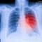 X-Ray Image Of Human Chest for a medical diagnosis, shows pain area with red. Thorax x-ray for lungs examination, PA up right