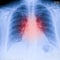 X-Ray Image Of Human Chest for a medical diagnosis, shows pain area with red. Thorax x-ray for lungs examination, PA up right