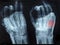 X-Ray image of human hands with top hand shown red