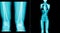 X-ray image of human have a long bone body