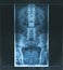 X-ray image human spine APl view in blue tone