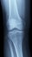 X-Ray image of a knee