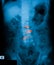 X-ray image of L-S spine, AP view.