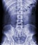 X-ray image of lambosacral spine or L-S spine