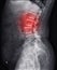 X-ray image of lambosacral spine or L-S spine showing lesion at L3