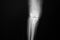 X-ray image of lanteroposteriorright knee joint with total knee replacement.