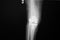 X-ray image of lanteroposteriorright knee joint with total knee replacement.